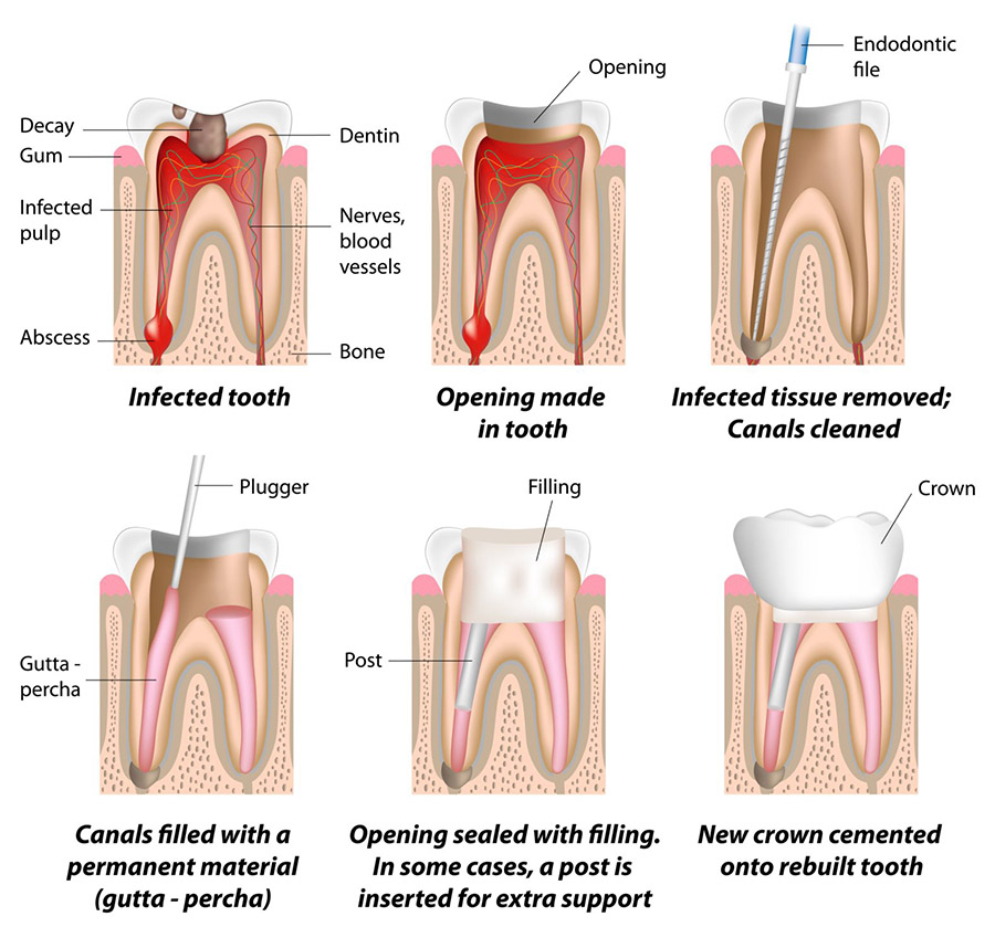 Root-Canal Treatment