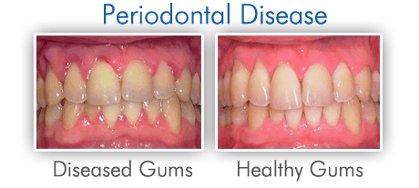 Tooth-Extraction