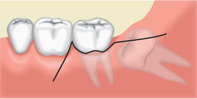 Gum Procedures