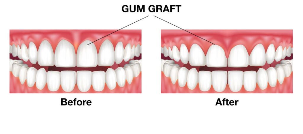 Gum Procedures