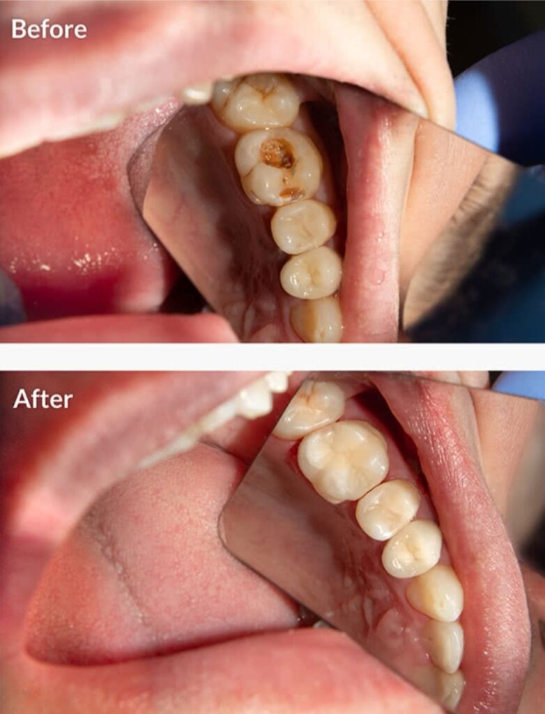 Dental Fillings