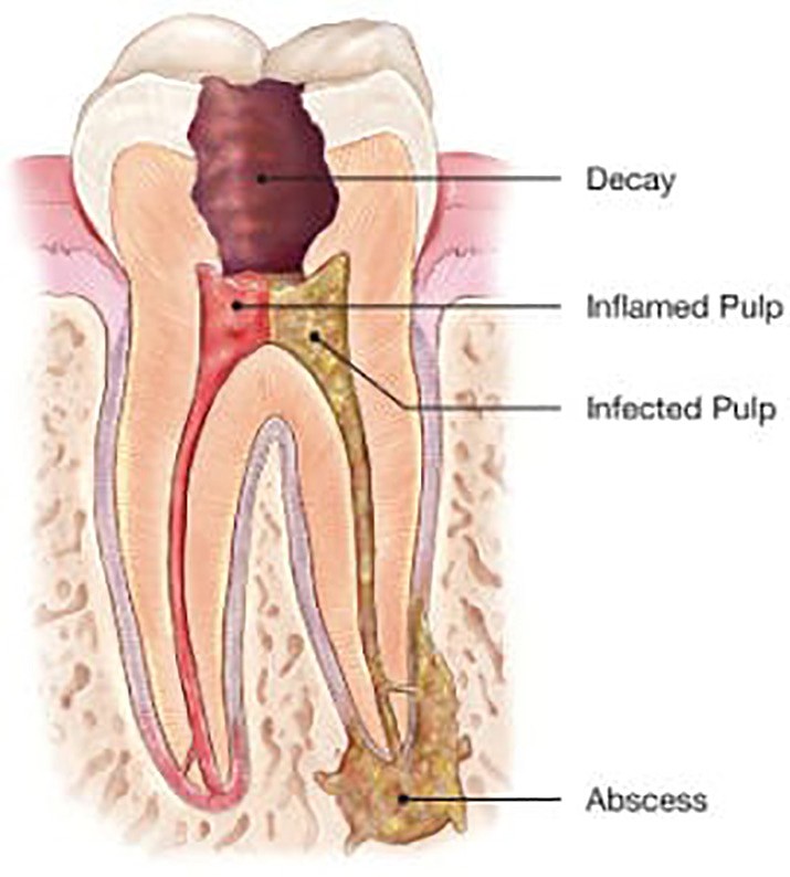 Root-Canal Treatment